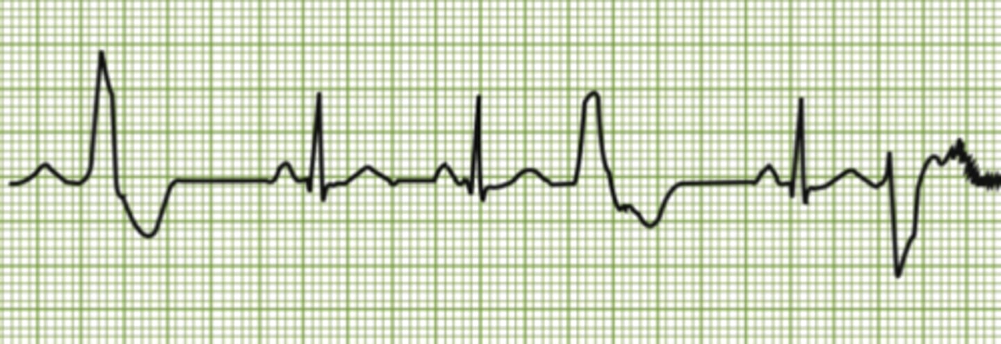 <p>"flutter" the QRS complex may randomly change length or orientation going upside down.</p>
