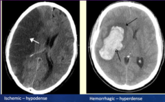 <p>more common</p><p>Caused by an obstruction of an artery leading to or in the brain, preventing oxygenated blood from reaching parts of the brain that the artery feeds</p>