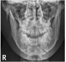 <p><span style="background-color: transparent;">Mandible PA for body</span></p>