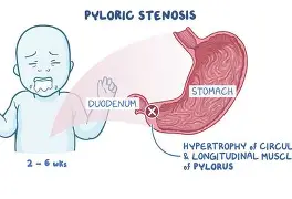 <p></p><ol><li><p><span style="color: rgb(247, 93, 93);"><strong>projectile, non-bilious vomit</strong></span></p></li><li><p><span style="color: rgb(89, 138, 50);"><strong>olive shaped mass in RUQ</strong></span></p></li><li><p><span style="color: rgb(206, 56, 222);"><strong>visible peristalsis</strong></span></p></li><li><p><span style="color: rgb(41, 76, 182);"><strong>metabolic alkalosis</strong></span> (vomiting)</p></li></ol><p></p>