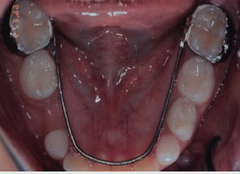 <p>what space maintainer:</p><p>- Lower arch</p><p>- Wire soldered to molar bands wraps around lingual surface of mandibular dentition to provide tooth support to maintain molar position and prevent mesial drift</p><p>- Contacts as many mandibular teeth as possible</p>