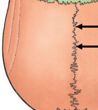 <p>Sagittal Suture</p>