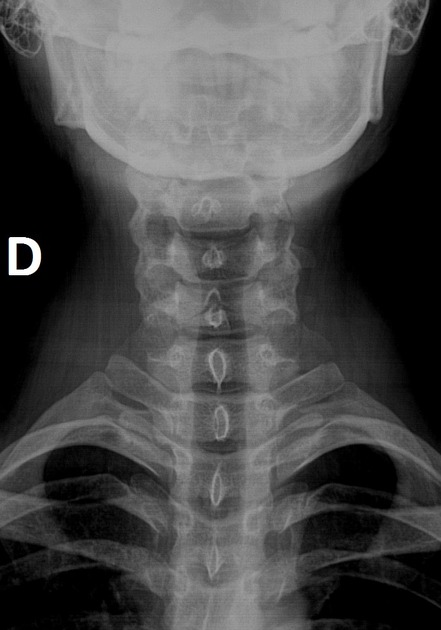 <p>What is the sign/finding and what is the likely diagnosis?</p>