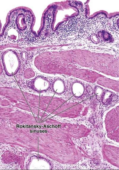 <p>what are the rokitanksy-aschoff sinuses of the gallbladder? when is it more prominent?</p>