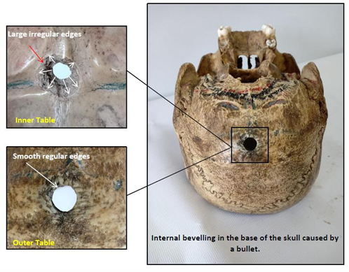 <p>Questions</p><ol><li><p>What is the specimen being examined?</p></li><li><p>What are the specific structural differences between the outer and inner table openings?</p></li><li><p>What is the precise anatomical location and diameter of the skull injury?</p></li><li><p>What type of causative instrument produced this injury?</p></li><li><p>How is the time of death estimated?</p></li><li><p>What are the possible causes of death?</p></li><li><p>What is the final diagnosis?</p></li></ol><div data-type="horizontalRule"><hr></div><p></p>