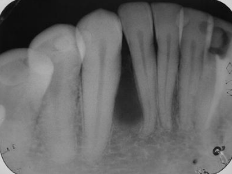 <p>A 51-year-old male patient presented with a well-delimited, radiolucent, mandibular lesion, located between the roots of the right lower lateral incisor and canine and evidenced during routine radiographic examination. Provide 2 differential diagnosis</p>