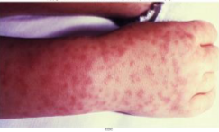 <p><strong><mark data-color="blue" style="background-color: blue; color: inherit;">Bacterial</mark></strong><mark data-color="blue" style="background-color: blue; color: inherit;"> skin disease</mark></p><p><strong><mark data-color="purple" style="background-color: purple; color: inherit;">[__]</mark></strong>: <mark data-color="yellow" style="background-color: yellow; color: inherit;">disease that results in rash on palms, wrists, ankles, and soles of feet. Spots become raised bumps and are hemorrhagic</mark></p><p>» replicates inside our cells</p><p><mark data-color="yellow" style="background-color: yellow; color: inherit;">» </mark><strong><mark data-color="yellow" style="background-color: yellow; color: inherit;">gram-negative infection</mark></strong><mark data-color="yellow" style="background-color: yellow; color: inherit;"> → </mark><strong><mark data-color="yellow" style="background-color: yellow; color: inherit;">can cause septic shock if destroyed</mark></strong></p><p>→ when systemic, causes damage to heart, kidneys, brain, other tissues leading to drop in blood pressure, shock, and death, without prompt treatment </p><p><u><mark data-color="blue" style="background-color: blue; color: inherit;">Spread</mark></u>: <mark data-color="yellow" style="background-color: yellow; color: inherit;">from animals to humans</mark> via <mark data-color="purple" style="background-color: purple; color: inherit;">tick bites</mark></p><p><mark data-color="purple" style="background-color: purple; color: inherit;">» American dog tick</mark></p><p><mark data-color="purple" style="background-color: purple; color: inherit;">» Rocky Mountain wood tick</mark></p><p><mark data-color="purple" style="background-color: purple; color: inherit;">» brown dog tick</mark></p><p><u><mark data-color="blue" style="background-color: blue; color: inherit;">Preventon</mark>:</u> avoid tick-infested areas</p><p>» use protective clothing; use tick repellents</p><p>» carefully inspect body and remove attached ticks carefully</p><p><u><mark data-color="blue" style="background-color: blue; color: inherit;">Treatment</mark></u>: <mark data-color="yellow" style="background-color: yellow; color: inherit;">antibiotics (more effective the earlier it is given) </mark></p><p><mark data-color="yellow" style="background-color: yellow; color: inherit;">→ </mark><strong><mark data-color="yellow" style="background-color: yellow; color: inherit;">doxycycline</mark></strong><mark data-color="yellow" style="background-color: yellow; color: inherit;"> </mark></p><p><mark data-color="yellow" style="background-color: yellow; color: inherit;">→ </mark><strong><mark data-color="yellow" style="background-color: yellow; color: inherit;">chloramphenicol</mark></strong><mark data-color="yellow" style="background-color: yellow; color: inherit;"> </mark></p><p>» 20% mortality rate without treatment; 5% with treatment</p>