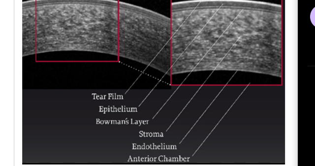 <p><span style="background-color: inherit; line-height: 20.7px; color: windowtext;">1 = pre corneal tear film</span><span style="line-height: 20.7px; color: windowtext;">&nbsp;</span></p><p class="Paragraph SCXO176295815 BCX0" style="text-align: left;"><span style="background-color: inherit; line-height: 20.7px; color: windowtext;">2 = corneal epithelium</span><span style="line-height: 20.7px; color: windowtext;">&nbsp;</span></p><p class="Paragraph SCXO176295815 BCX0" style="text-align: left;"><span style="background-color: inherit; line-height: 20.7px; color: windowtext;">3 = corneal stroma</span><span style="line-height: 20.7px; color: windowtext;">&nbsp;</span></p>