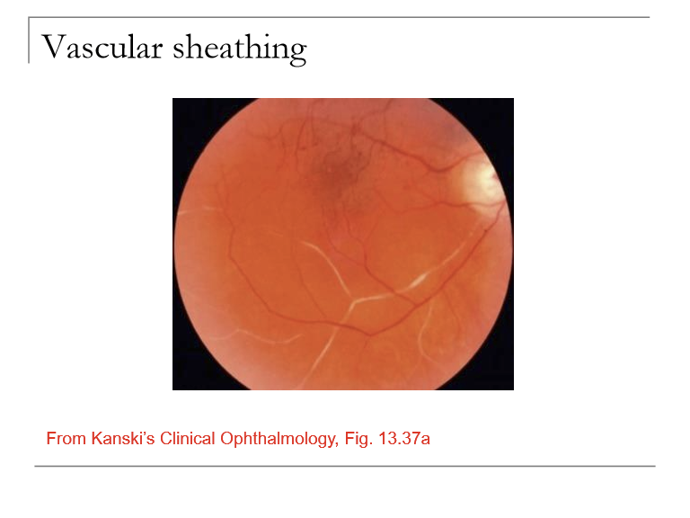 <ul><li><p>Deposition/thickening of retinal blood vessel walls</p></li><li><p>Materials include lipid, collagen, fibrin, hyaline, calcium</p></li></ul><p></p>