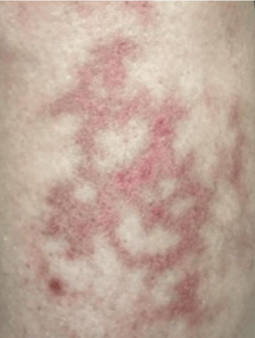 <p>Reticular</p>
