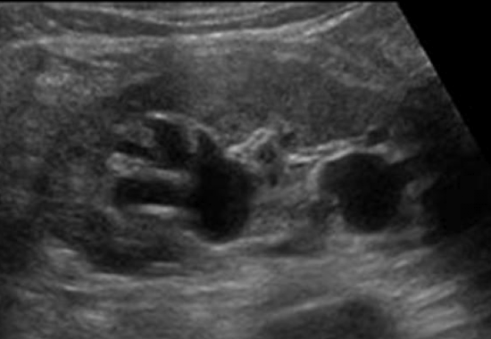 <p>cysts located in the renal sinus </p><ul><li><p>do not communicate with collecting system </p></li></ul><p></p>