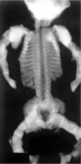 <p>3 definitions of fetal shortened long bones: biparietal diameter (BPD) to femur or humerus length (FL, HL) ratio of greater than 1.5 standard deviations above the mean for gestational age; observed to expected (O/E) femur and humerus length ratio of <0.92 and <0.90, respectively; femur and/or humerus length less than the fifth percentile for gestational age.</p>