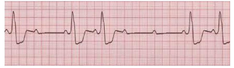 <p>howd you know this was mobitz II atrioventricular block w sinus rhythm</p>