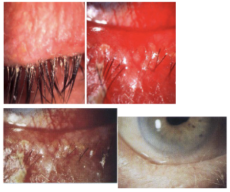<p><span style="background-color: transparent;">_______<strong> Blepharitis</strong>:</span></p><ul><li><p><span style="background-color: transparent;">Symptoms usually worse in the _______</span></p></li><li><p><span style="background-color: transparent;">_______ Blepharitis</span></p><ul><li><p><span style="background-color: transparent;">Hard scales + crusting around eyelash bases, called collarettes scarring and notching of the lid margin, trichiasis (misdirected eyelashes), loss of lashes or pigmentation of lashes in severe long-standing cases</span></p></li><li><p><span style="background-color: transparent;">Frequent with:</span></p><ul><li><p><span style="background-color: transparent;">Eyelash <u>loss</u></span></p></li><li><p><span style="background-color: transparent;">Eyelash <u>misdirection</u></span></p></li><li><p><span style="background-color: transparent;"><u>Matted, hard scales/collarettes</u> (eyelid deposits)</span></p></li><li><p><span style="background-color: transparent;">Eyelid <u>ulceration</u> with severe exacerbations</span></p></li><li><p><span style="background-color: transparent;"><u>Mild-to-moderate</u> injection, phlyctenules may occur (Conjunctiva)</span></p></li><li><p><span style="background-color: transparent;">Aqueous Tear Deficiency</span></p></li><li><p><span style="background-color: transparent;"><u>Inferior</u> punctate epithelial erosions, peripheral/marginal infiltrates (10, 2, 4, and 8 o’clock), scarring, neovascularization and pannus, thinning, phlyctenules (cornea)</span></p></li><li><p><span style="background-color: transparent;">Derm Disease: <u>atopy</u> rarely</span></p></li></ul></li></ul></li></ul><p></p>
