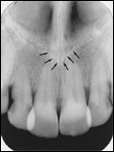 <p>Radiopaque V-shaped structure above maxillary central incisors</p>