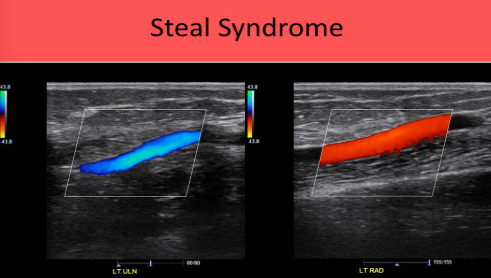<p>Dialysis access steal syndrome </p>