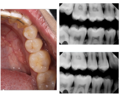 <p>What is the treatment for #29?</p><p>Findings:</p><p>- Visual: Occlusal-Initial</p>