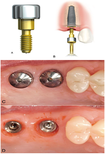 <p><span>are dome-shaped intraimplant screws that provide permucosal access to the implant platform</span></p><p><span style="color: rgb(255, 0, 0);">• are placed immediately after a one-stage surgical approach or after uncovering in a two- stage surgical approach</span></p><p><span>• should project </span><span style="color: rgb(255, 0, 0);">1 to 2 mm </span><span>superior to the height of the gingival tissue</span></p>