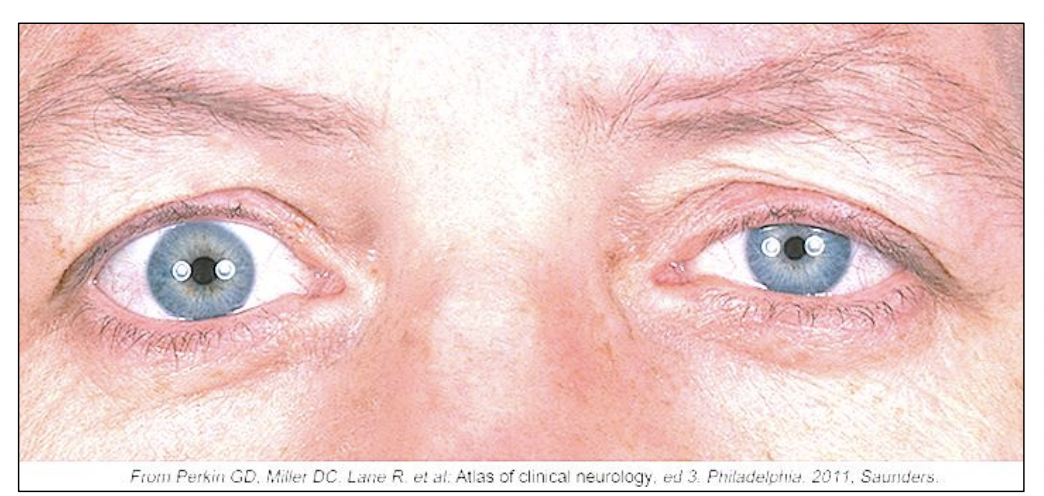 <p>Signs are on the same side (ipsilateral) as the lesion </p><ul><li><p>ptosis: partial drooping of the eye lid (superior tarsal muscle) </p></li><li><p>miosis: pupillary constriction </p></li><li><p>anhidrosis (Hypohidrosis): lack (or decrease) of sweating </p></li><li><p>enophthalmos: eye appears to sink into the orbit </p></li></ul><p></p>
