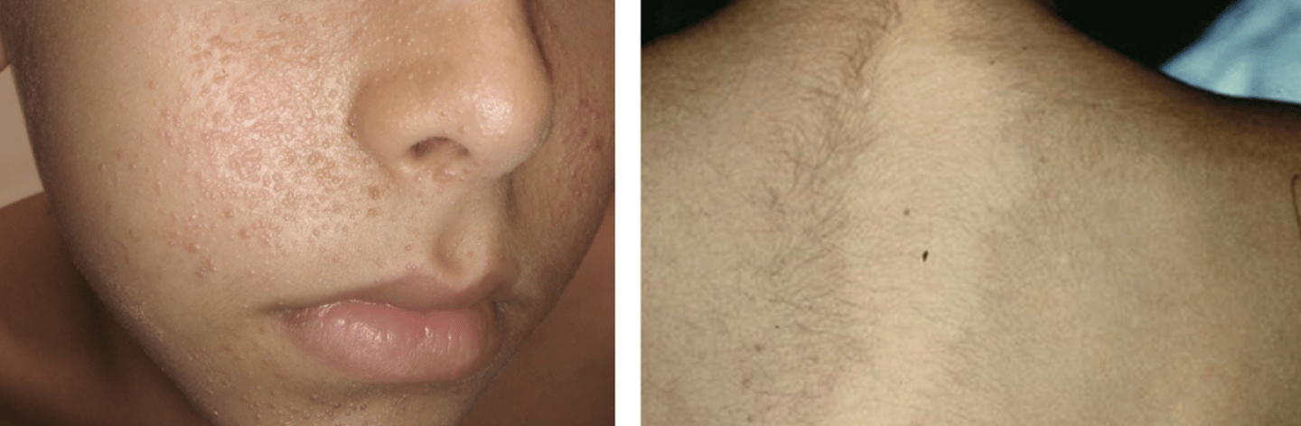 <p>Hypomelanotic macules, Facial Angiofibromas, Fibrous plaques</p>