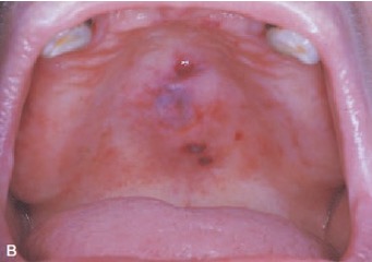 <p>What type of lesion is this?</p>