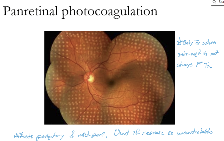 <p>PRP is used when there is widespread retinal hypoxia, leading to neovascularization, such as in proliferative diabetic retinopathy or retinal vein occlusions with NV.</p>