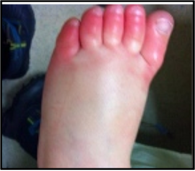 <p>numbness, erythema, welling, dysesthesia, white plaques, no loss of tissue</p>