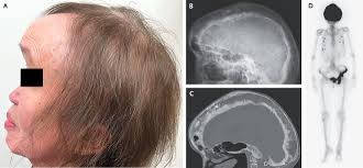 <p>Excessive osteoclastic activity which increase bone breakdown, followed by disorganised osteoblastic repair - bone is dense but structurally weak leading to enlarged, deformed bones prone to fracture </p><p>Commonly affects the skull, pelvis, spine, femur and tibia </p>