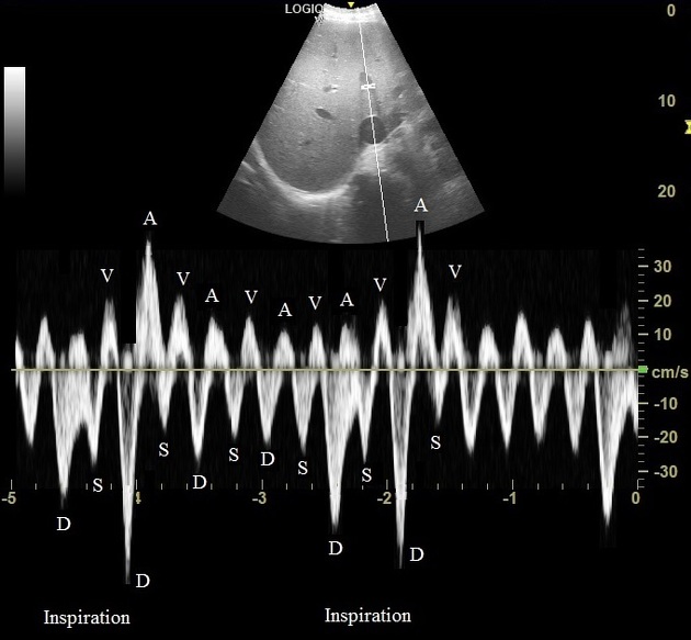 <p>Imaging of hepatic veins. What are the findings and suspected diagnoses.</p>