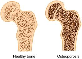 <p><span style="line-height: 107%;"><strong>BOOK:</strong></span></p><p class="MsoNormal"><span>Decreased bone mass leading to risk of bone fractures. This bone loss is related to the effects of aging, genetic background, poor diet, and hormonal changes occurring in postmenopausal women.</span></p><p class="MsoNormal"><span style="line-height: 107%;"><strong>SIMPLE:</strong></span></p><p class="MsoNormal">A <span style="font-family: Calibri, sans-serif;">bone disease</span> in which <span style="font-family: Calibri, sans-serif;">bones become weak and brittle</span>, making them <span style="font-family: Calibri, sans-serif;">more likely to break</span>.</p>