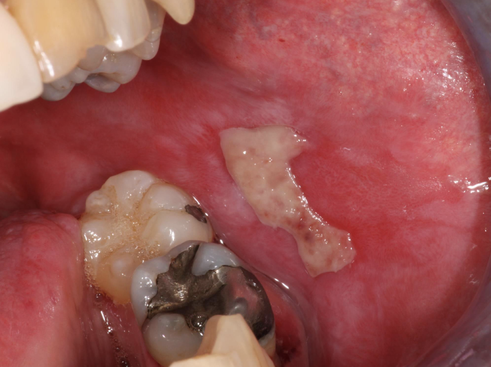 <p>what condition?</p><p>• Least common form</p><p>• Usually symptomatic</p><p>• Ulcers with striae and erythema</p>