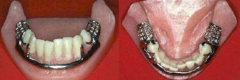 <p>ID the type of mandibular major connector:</p>