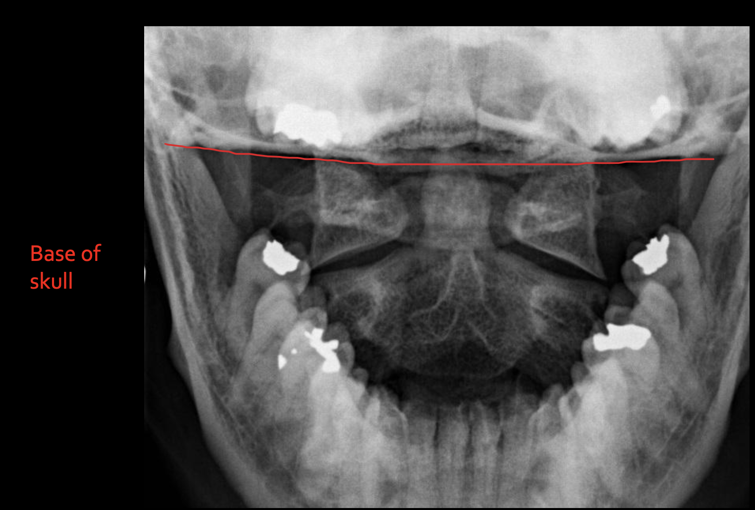 <p><span>Base of skull</span></p>