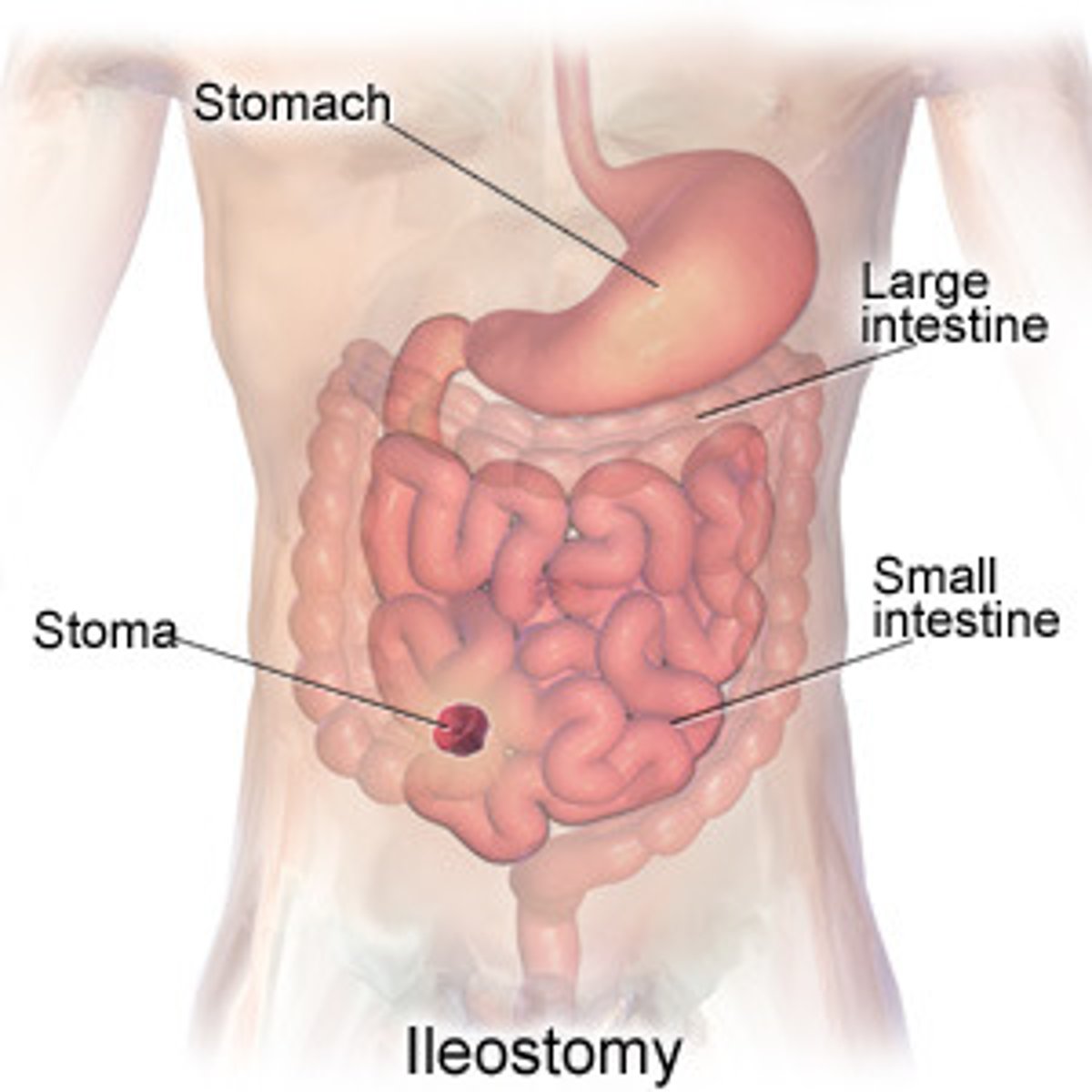<p>ileostomy</p>