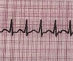 <p><span>supraventricular tachycardia (SVT) (above ventricles)</span><br><span>also called paroxysmal supraventricular tachycardia</span><br><span>-adenosine to identify underlying heart rate</span></p>
