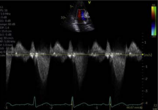 <p>explain what you see the shape dont forget the cardiac cycle when does it peak and wht kind of raising is this</p>
