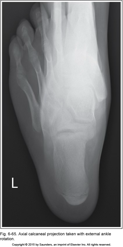 <p>axial calcaneus</p>