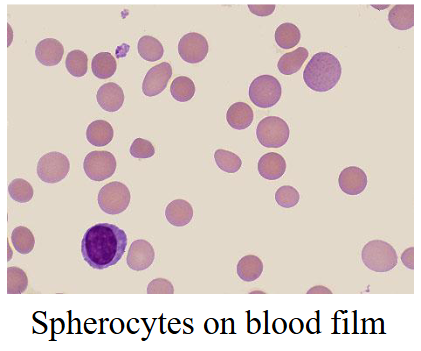 <p>- Most common inherited haemolytic anaemia</p><p>- Autosomal dominant with variable severity</p><p>- Defect in a structural RBC membrane protein: Spectrin; ankyrin; band 3</p><p>- RBC less deformable and lose membrane when passing through spleen</p><p>- Red cells become spherical, rigid and then destroyed</p><p>.</p><p>- in this case there was no central pallor</p><p>- Central pallor refers to the pale-staining, white center of a normal red blood cell (erythrocyte) seen on a blood smear, occupying about one-third of its diameter</p>