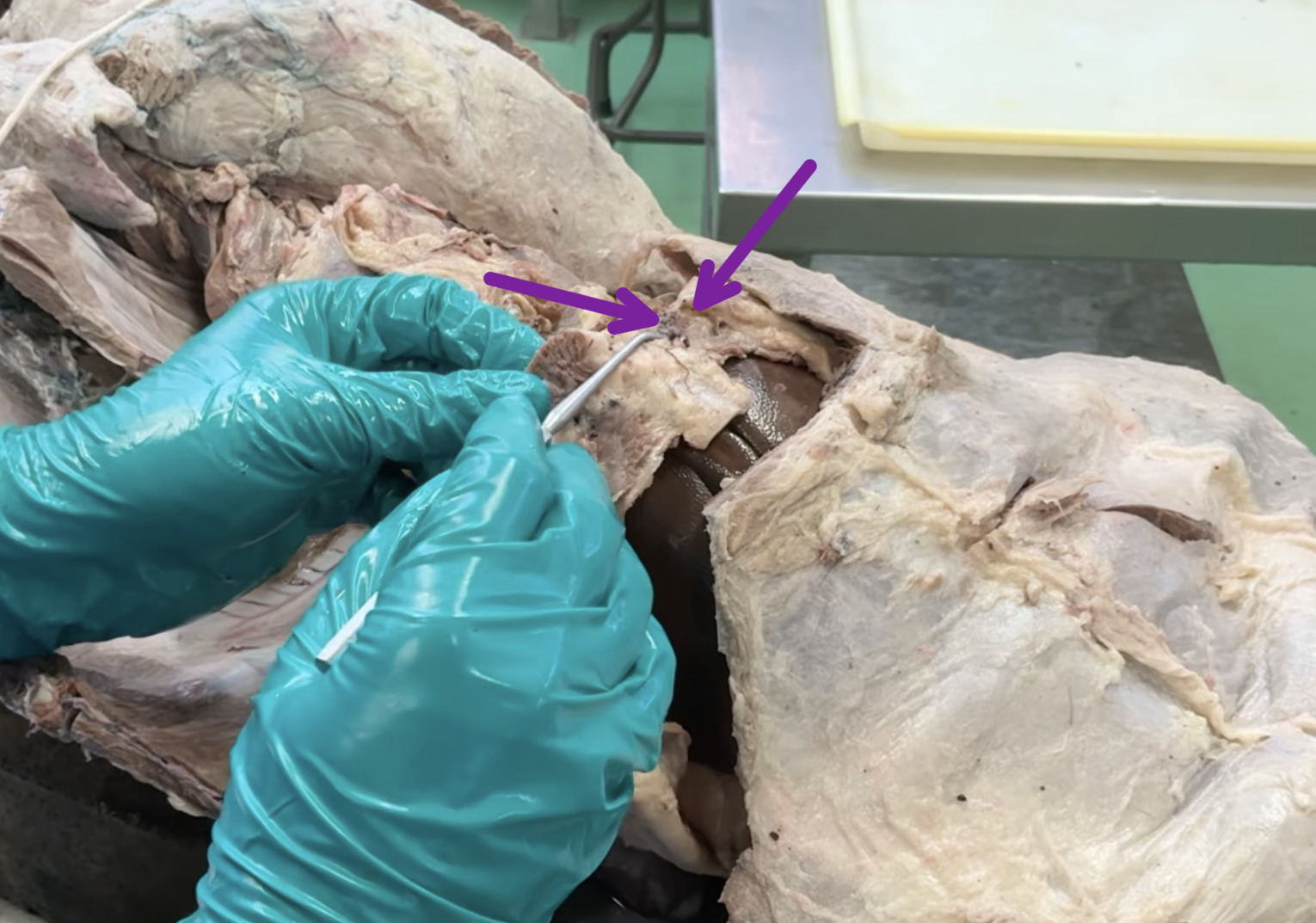 <p>If this artery was deep to the abdominal muscles, it would be?</p>