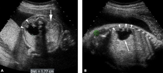 <ul><li><p>medial anechoic urine collection within renal pelvis that communicates with calyces (caliectasis)</p></li><li><p>moderate to severe hydronephrosis without hydroureter or bladder dilation</p></li><li><p>distended renal calyces connect with renal pelvis</p></li><li><p>enlarged kidney</p></li><li><p>if unilateral, bladder and AFI are normal</p></li><li><p>if bilateral, bladder will be empty and may have oligohydramnios </p></li></ul><p></p>