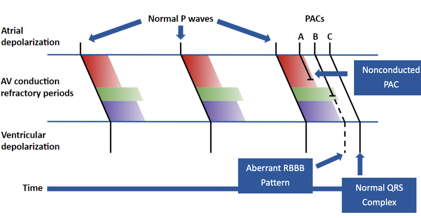 <p>A: Nonconducted PAC</p><p>B: Aberrant RBBB Pattern</p><p>C: Normal QRS Complex</p>