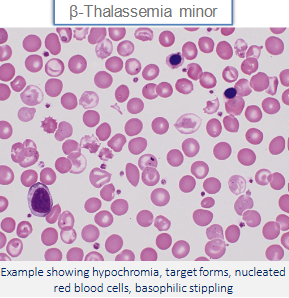 <ul><li><p>1 absent + 1 normal (B0/B) OR 1 mutated + 1 normal (B+/B)</p><ul><li><p>peripheral smear → hypochromasia, microcytosis, basophilic stippling, target cells, nucleated RBC</p></li><li><p>BM → mild erythroid hyperplasia</p></li></ul></li><li><p>mutation on both B chains (B+/B+) OR 1 mutated + 1 absent (B+/B0)</p><ul><li><p>variable, ranges form mild/asymptomatic to severe/transfusion dependent</p></li></ul></li></ul><p></p>