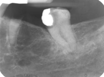 <p>75% in adult women; typically post mand </p>
