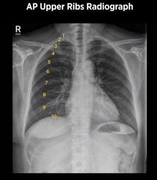 <p>10 posterior ribs</p>