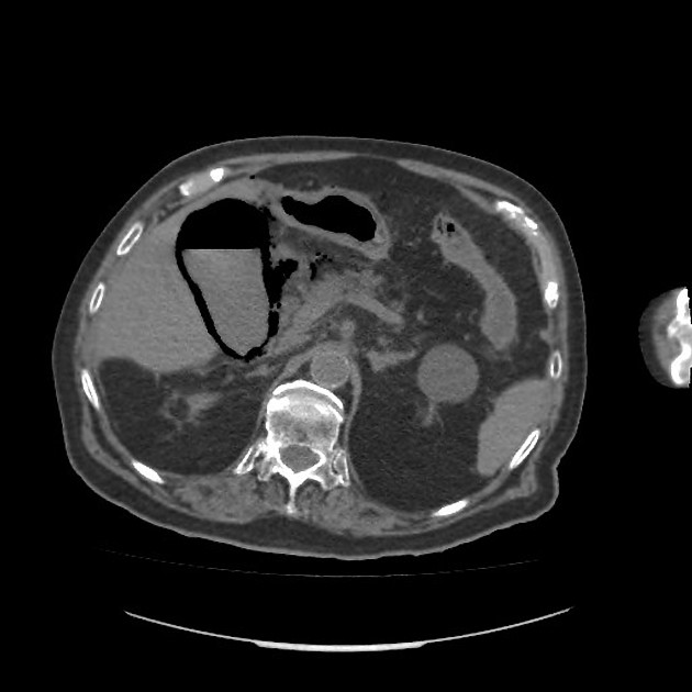 <p>Etiology of emohysematous cholecystitis and at-risk patients.</p>