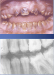 <p>-Normal thickness of enamel but No calcification at all </p><p>-Soft enamel - "Swiss Cheese"</p><p>-Brown due to extrinsic stains </p><p>-NOT prone to caries</p>