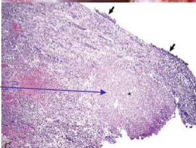 <p>suppurative (neutrophilic) inflammation of pelvis with necrotic transitional</p><p>epithelium (short arrows) and renal medullary necrosis</p>