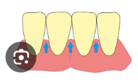 <p>Space between 2 adjacent teeth </p>