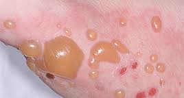 <p>>1cm, superficial in epidermis (contact dermatitis, burns)</p>