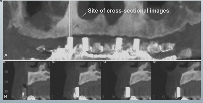 <p>-providers fabricate a diagnostic stent or radiographic guide, depending on the case</p><p>-stents provide fiducial radiographic landmarks that can be used to correlate the proposed clinical location and angulation of implants with the available alveolar bone</p><p>-pan projection in A provides an overview of the location</p><p>-serial cross-sections in B indicate alveolar bone height</p>